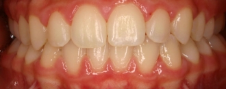 Croppedimage330130 Cross Bite After