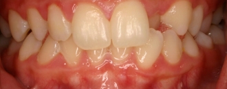 Croppedimage330130 Cross Bite B4