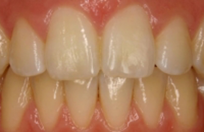 Croppedimage330130 Gappy Teeth After