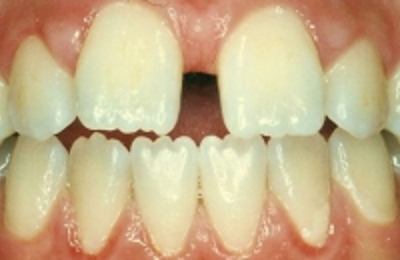 Croppedimage330130 Gappy Teeth B4