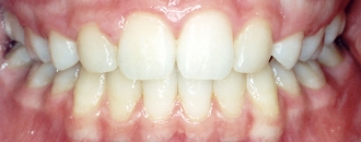 Croppedimage330130 Missing Teeth After