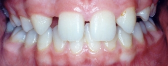 Croppedimage330130 Missing Teeth B4
