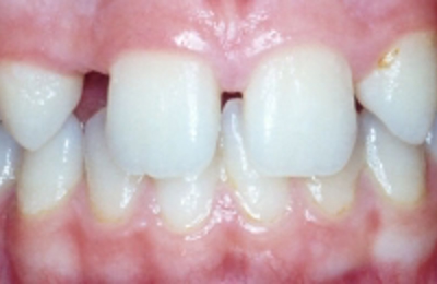 Croppedimage330130 Missing Teeth B4