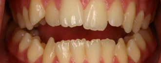 Croppedimage330130 Open Bite B4