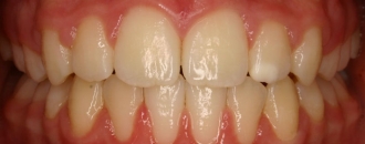 Croppedimage330130 Prominent Teeth Centre After