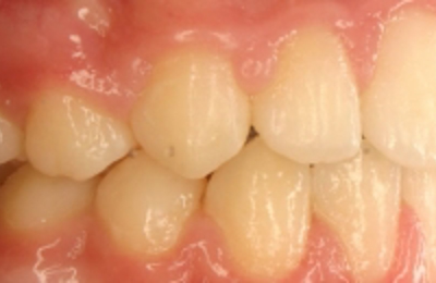 Promient Back Tooth Smile Gallery