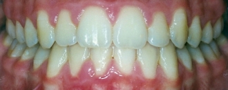 Croppedimage330130 Under Bite After