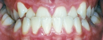 Croppedimage330130 Under Bite B4
